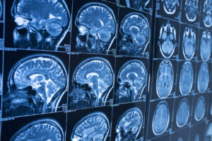 Why Choose Kenny Ramirez Law Firm Personal Injury Lawyers if You’ve Suffered a Brain Injury in San Bernardino, CA?